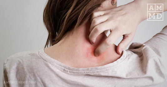 Woman Scratching Rash on Back of Neck - Natural Psoriasis Treatment from the Inside Out - Amy Myers MD®